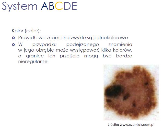 czerniak rozpoznanie C